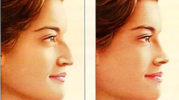 آنچه باید قبل از جراحی بینی بدانید