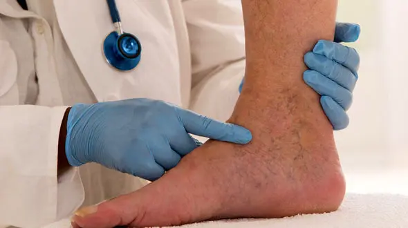 درمان  دردهای واریس با 5 شیوه ساده/ اگر  درد  پا دارید درمان تان اینجاست