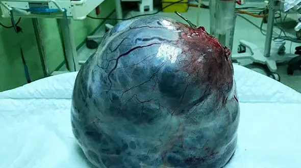 این شی 6 کیلویی در شکم زن اردبیلی بود + عکس 