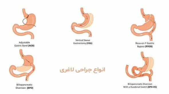 خطر مرگ در اثر جراحی لاغری - از شایعه تا واقعیت
