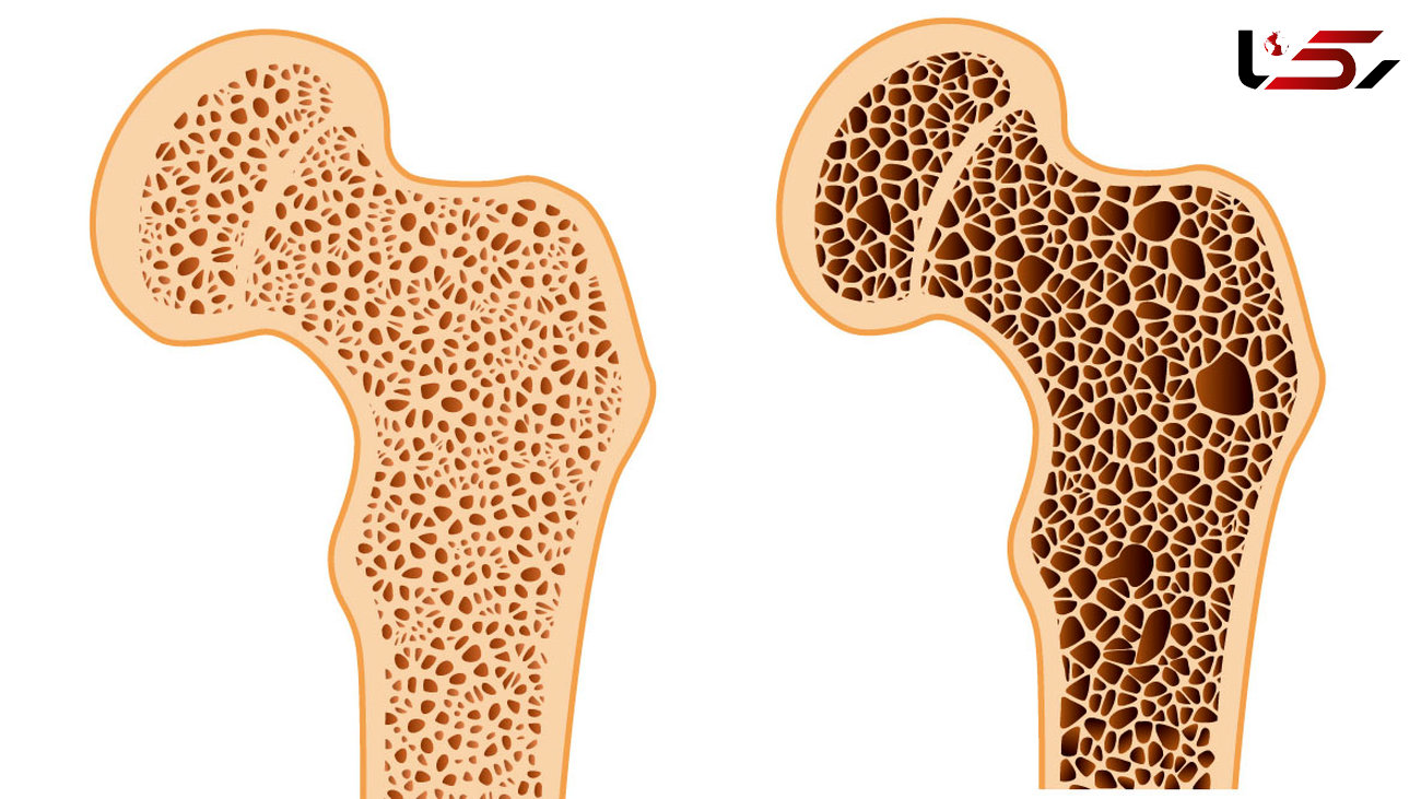 چرا زنان مستعد ابتلای به پوکی استخوان هستند؟