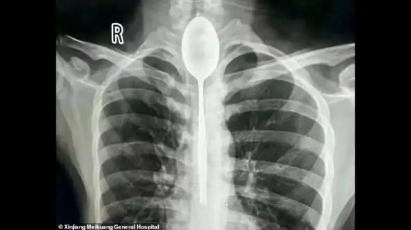 یک سال زندگی این مرد با قاشقی در گلو + عکس