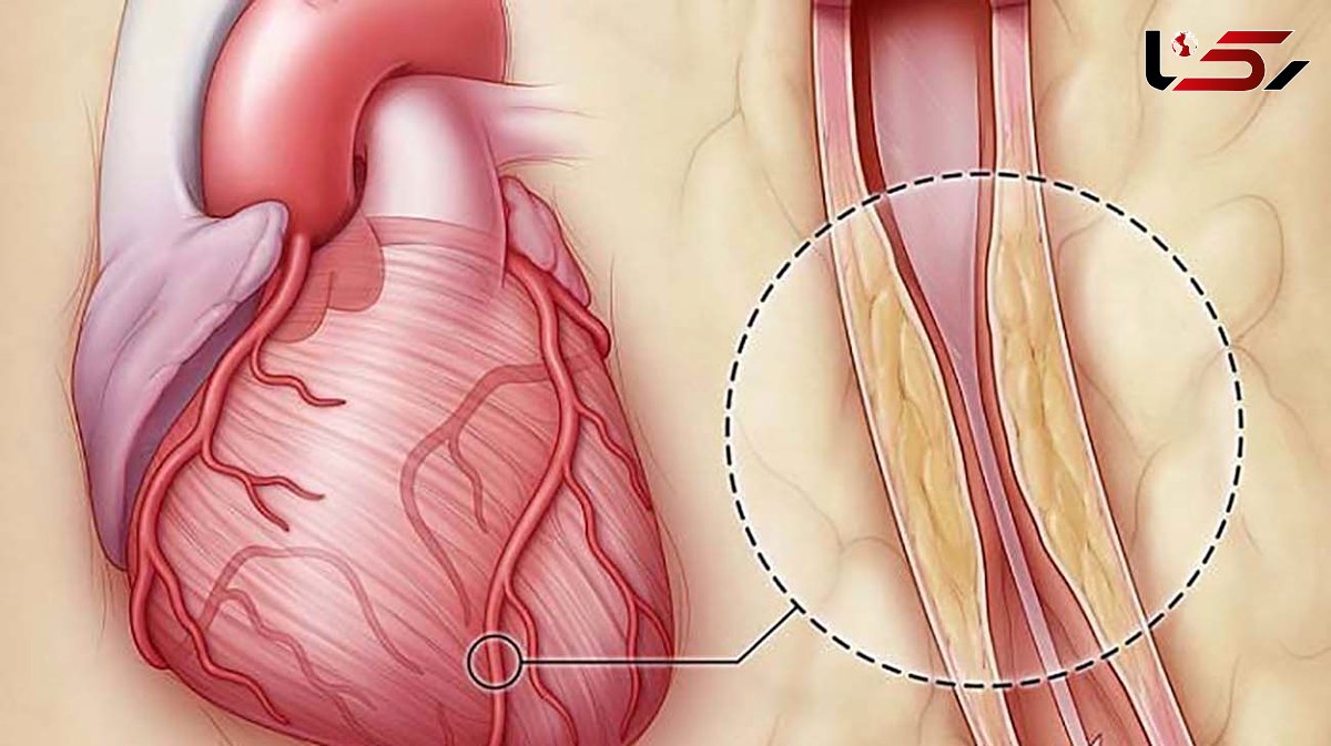 بهترین خوراکی ها برای باز شدن رگ های قلب / عوامل بسته شدن رگ قلب