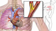  آنژین قلبی چیست؟