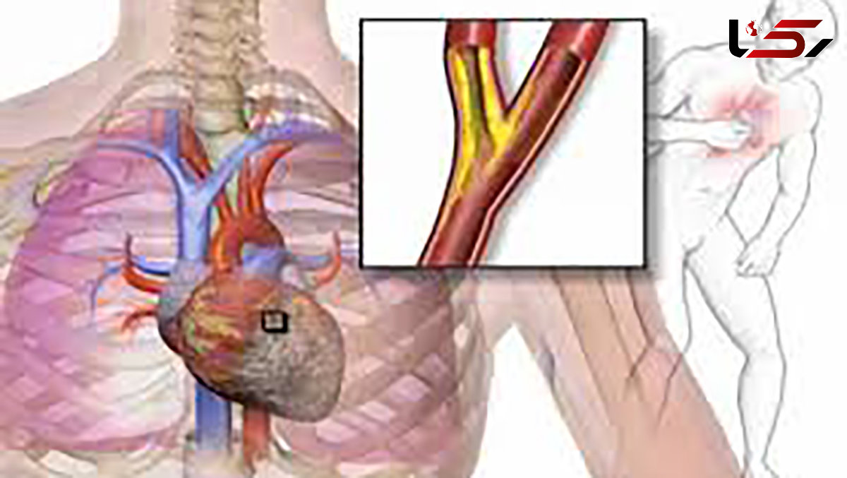  آنژین قلبی چیست؟