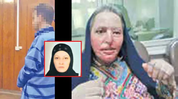 عکس قبل و بعد چهره زن آرایشگر کرجی که عشق کور فرهاد آن را سوزاند!