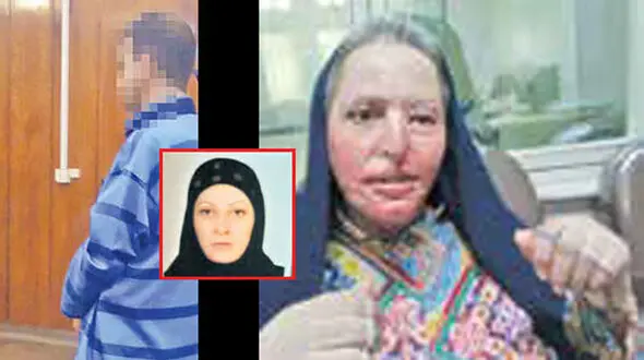 عکس قبل و بعد چهره زن آرایشگر کرجی که عشق کور فرهاد آن را سوزاند!