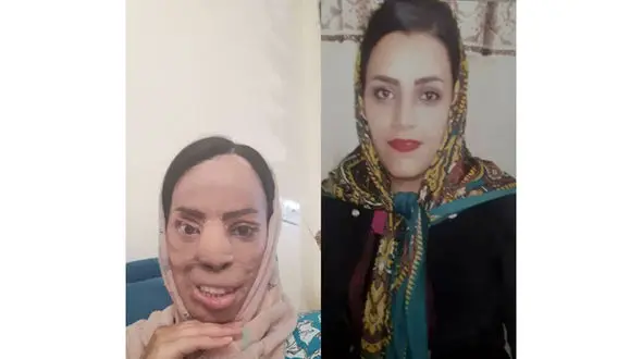 چهره عروس جوان تهرانی با اسید سوخت + عکس قبل و بعداز حادثه