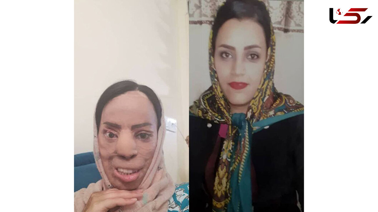 چهره عروس جوان تهرانی با اسید سوخت + عکس قبل و بعداز حادثه