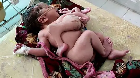 تولد نوزاد عجیب الخلقه هندی با 4 پا و سه دست+ تصاویر حیرت‌آور