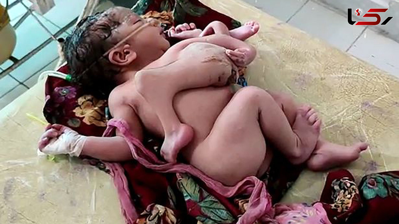 تولد نوزاد عجیب الخلقه هندی با 4 پا و سه دست+ تصاویر حیرت‌آور