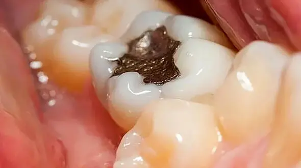 روش های درمان خانگی پوسیدگی دندان