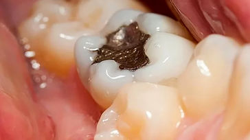 روش های درمان خانگی پوسیدگی دندان