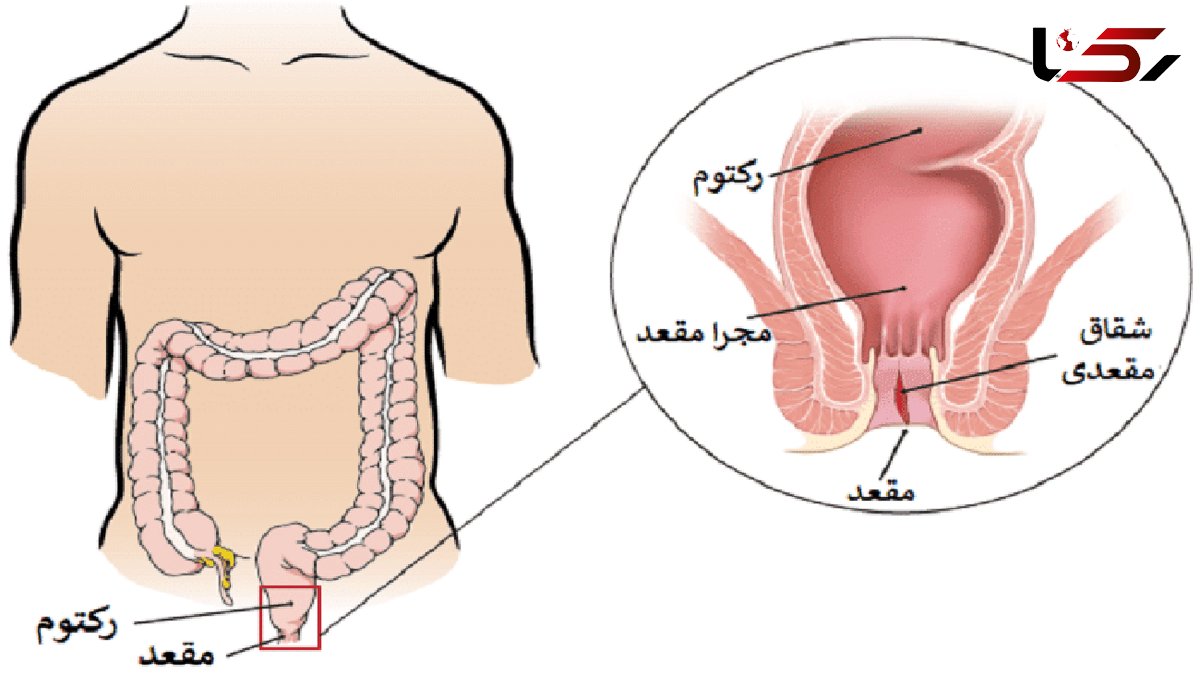 شقاق چیست؟ / جداول مرتبط با شقاق + فیلم