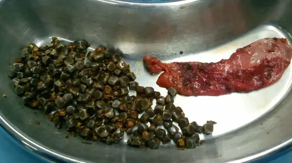سنگ کیسه صفرا چطور تخلیه می شود؟ + فیلم 