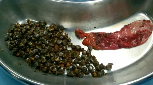 سنگ کیسه صفرا چطور تخلیه می شود؟ + فیلم 