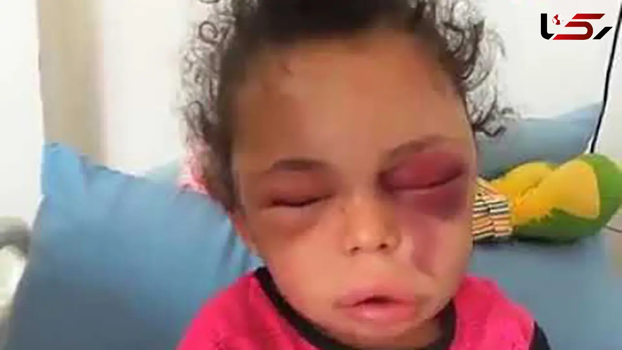 چهره داغون سرنوشت دختر ۵ ساله ! + جزییات