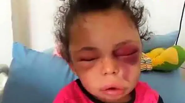 چهره داغون سرنوشت دختر ۵ ساله ! + جزییات