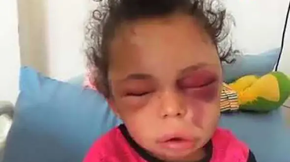 چهره داغون سرنوشت دختر ۵ ساله ! + جزییات