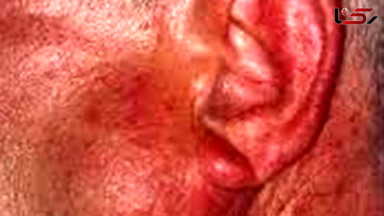 گوش درد می تواند نشانه یک نوع سرطان باشد