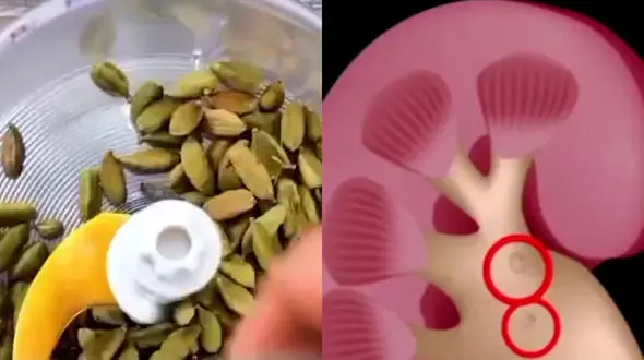 شما هم سنگ کلیه دارین؟ از مصرف هل غافل نشین / فیلم