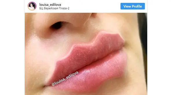 
لب‌های اختاپوس، جدیدترین مدل جراحی زیبایی
