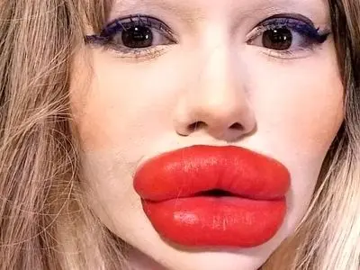 رکورد عجیب زنی با بزرگترین لب دنیا؛ همه چیز درباره هزینه‌ های هنگفت! / عکس