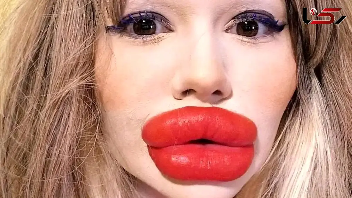 رکورد عجیب زنی با بزرگترین لب دنیا؛ همه چیز درباره هزینه‌ های هنگفت! / عکس