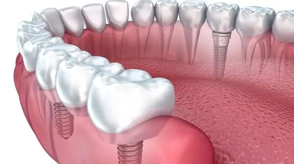 بهترین زمان ایمپلنت دندان چه زمانی است؟