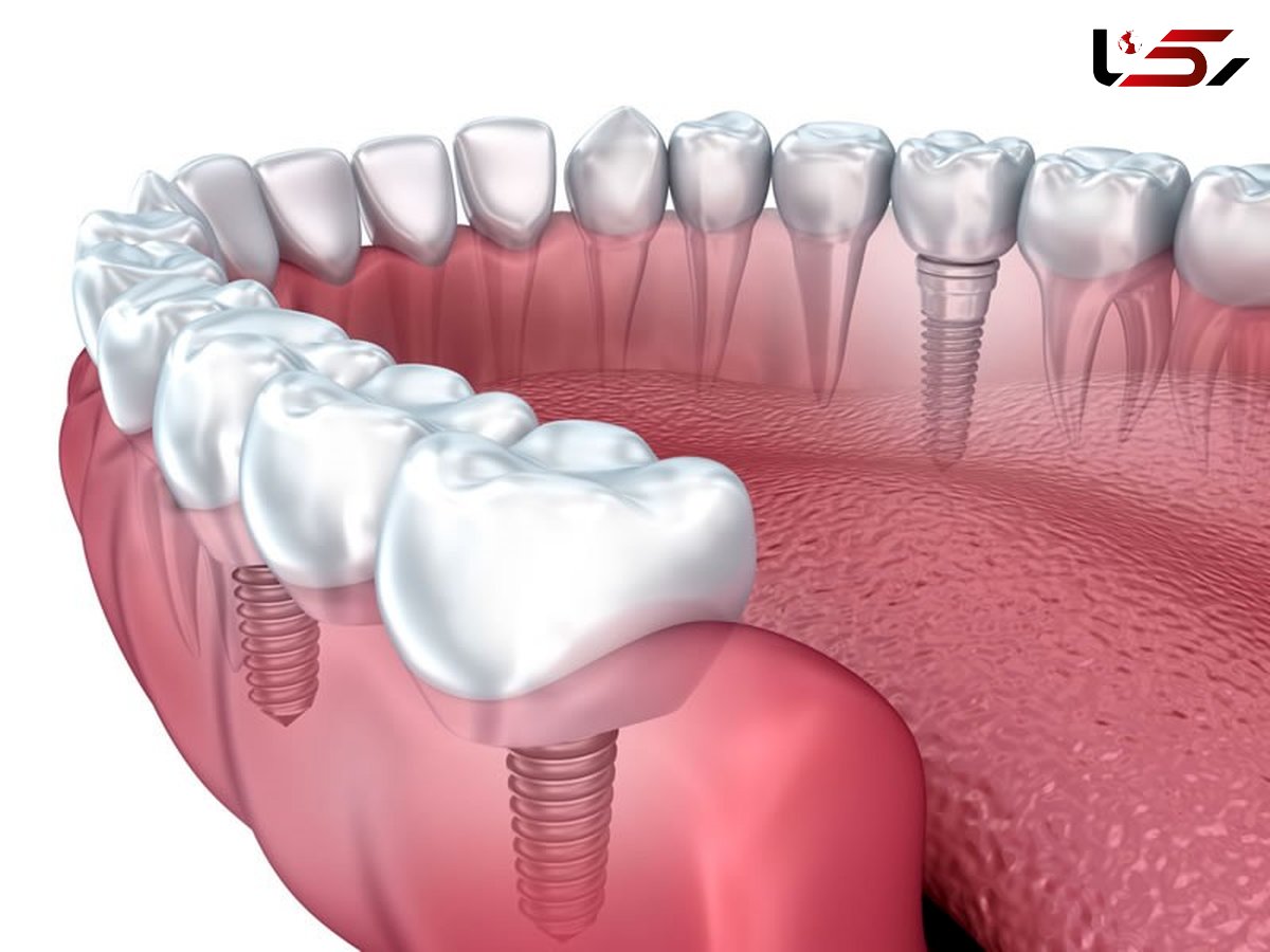 بهترین زمان ایمپلنت دندان چه زمانی است؟