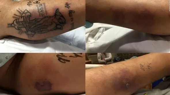 مردی به خاطر خالکوبی مُرد+عکس 