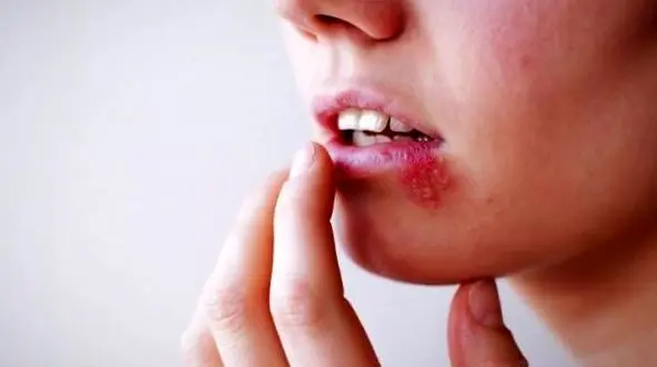 درمان  تبخال با ترفندهای خانگی