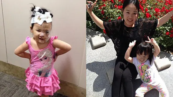 دختری که تنها نیمی از صورتش سالم است + تصاویر(+16) 