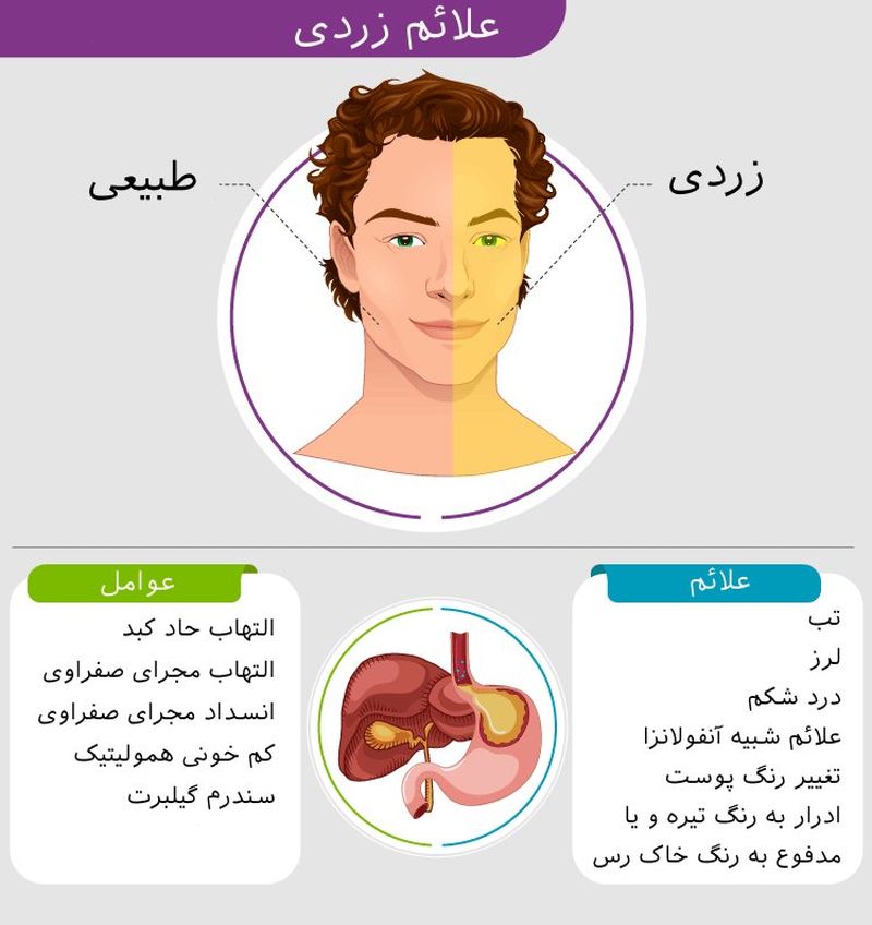 علائم زردی یرقان