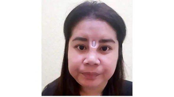 یادگاری وحشتناک جراح بینی در صورت دختر جوان + عکس