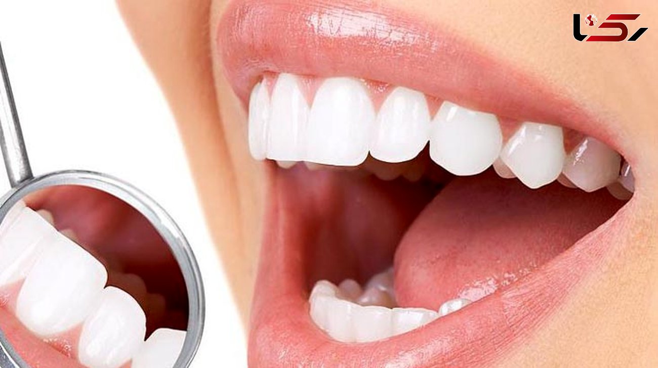  200 میلیون دندان پوسیده در دهان ایرانیان 