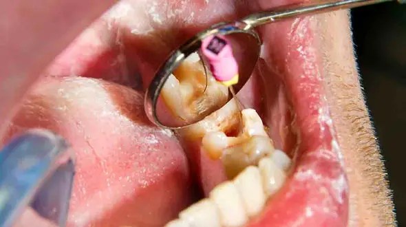 از عصب کشی دندان فرار نکنید!