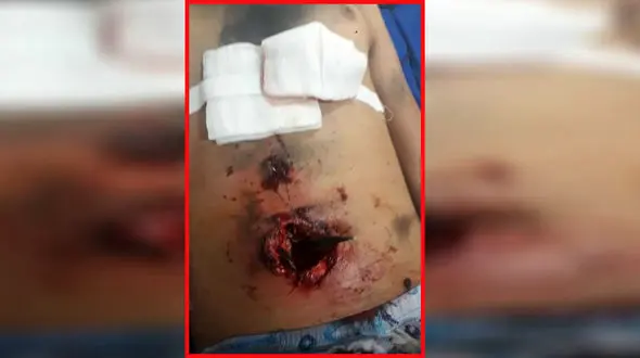 عکس وحشتناک از ترکیدن نارنجک دست ساز در شکم پسر جوان کرمانی / 16+