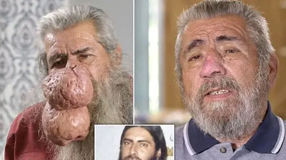 بینی خرطوم فیلی این مرد خبرساز شد + عکس ها