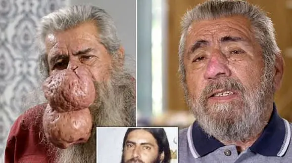 بینی خرطوم فیلی این مرد خبرساز شد + عکس ها