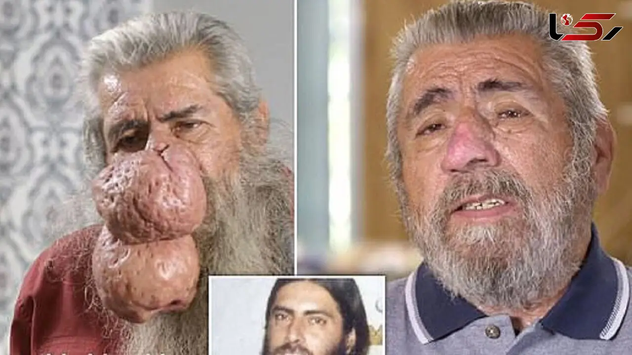 بینی خرطوم فیلی این مرد خبرساز شد + عکس ها