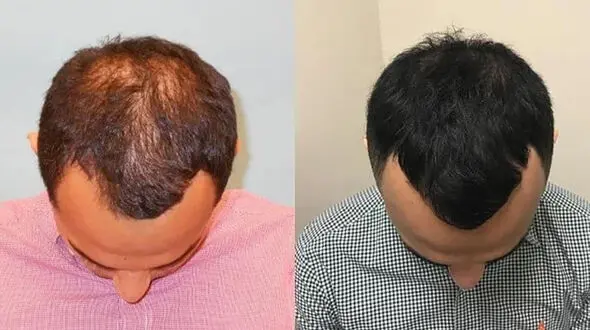 پی آر پی مو چیست؟+ فیلم 