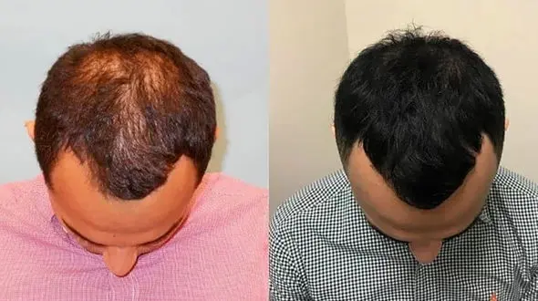 پی آر پی مو چیست؟+ فیلم 