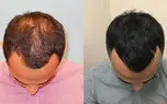 پی آر پی مو چیست؟+ فیلم 