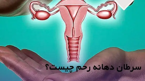 سرطان رحم چیست؟ / عوامل پیشگیری از سرطان رحم 