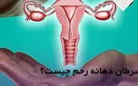 سرطان رحم چیست؟ / عوامل پیشگیری از سرطان رحم 