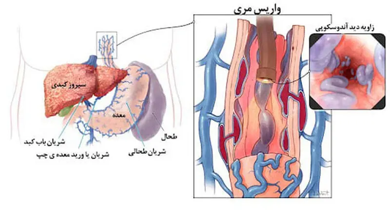 سیروز کبدی