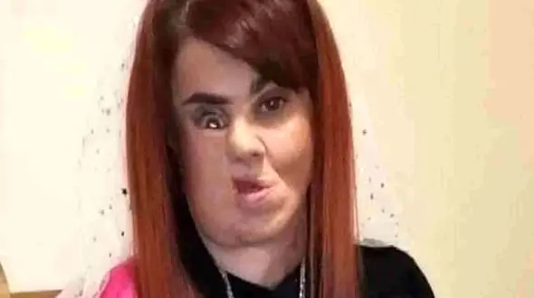 حشره گوشتخوار صورت دختری را خورد ! + عکس های تلخ