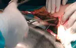 جراحی چندش آور/ خارج کردن گلوله مویی بزرگ از شکم دختر نوجوان+ تصاویر