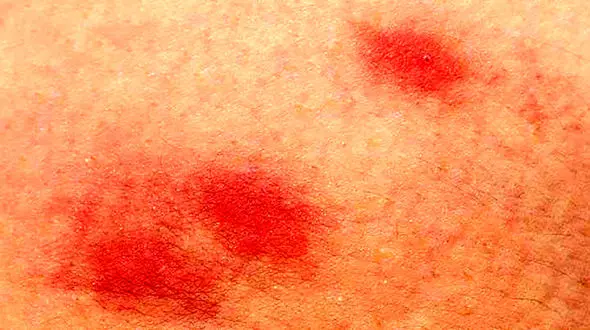 برای تسکین خارش و سوزش نیش حشرات چه کنیم؟